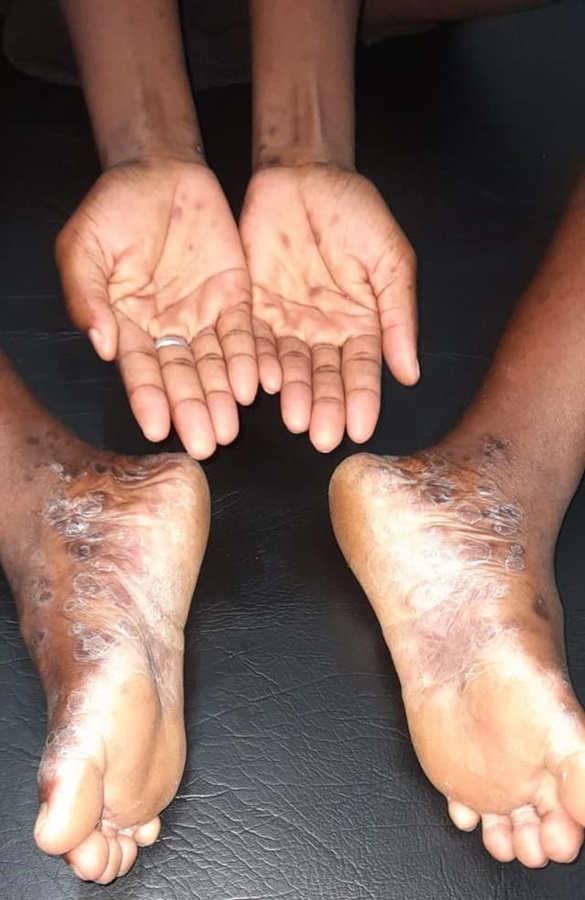 Verdachte vlekken op de handpalmen en voetzolen kunnen duiden op syfilis. [Foto: Dienst Dermatologie]