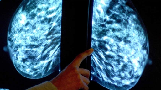 Foto: Mammogram voor een controle op borstkanker. 