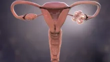 Hormonale aandoening die miljoenen vrouwen treft krijgt nieuwe naam