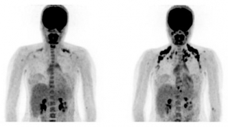 PET-scans van een proefpersoon vóór en ná koudeblootstelling